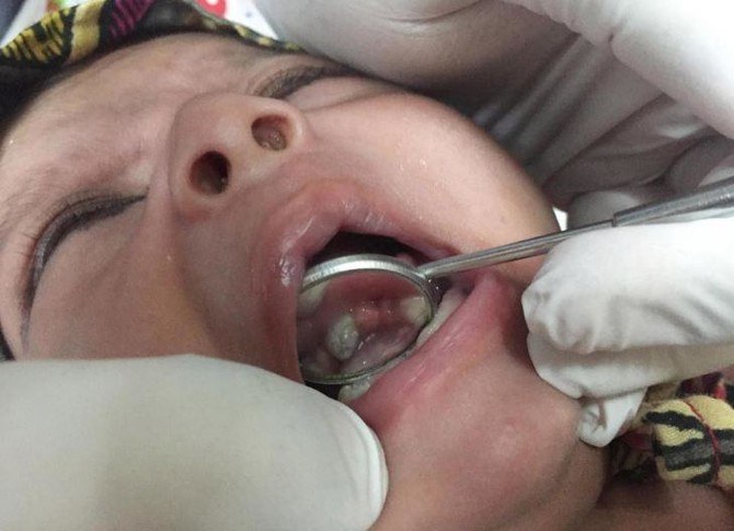 Baby born with seven teeth shocks doctors, but was he a world first?