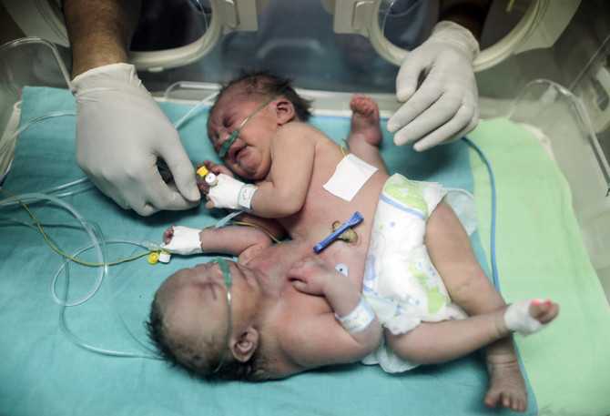 Palestinian conjoined twins separation surgery successful